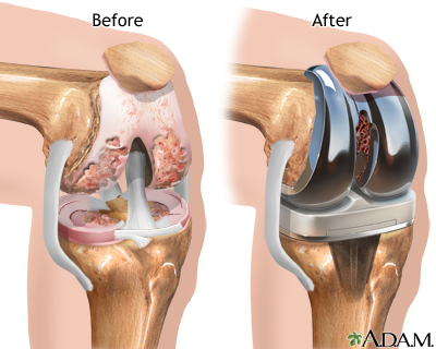 knee-pain