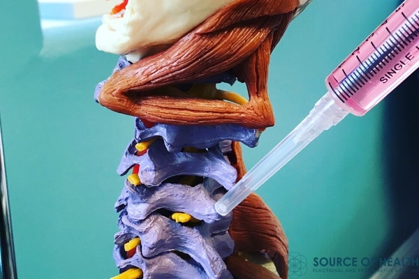prolotherapy