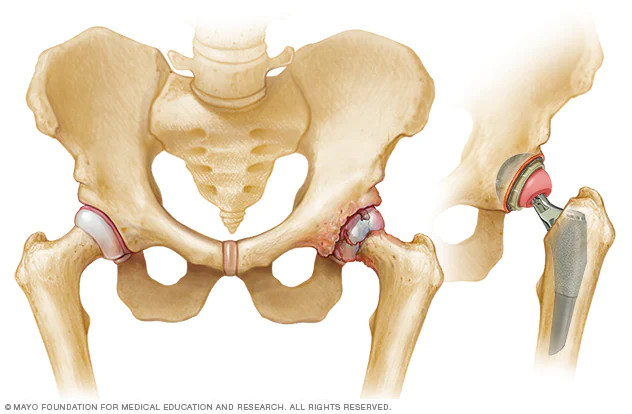 Hip-resurfacing